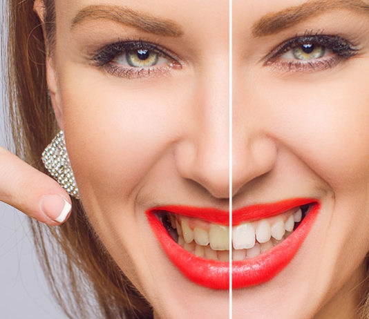 Wybielanie zębów magic white – czy warto się skusić?
